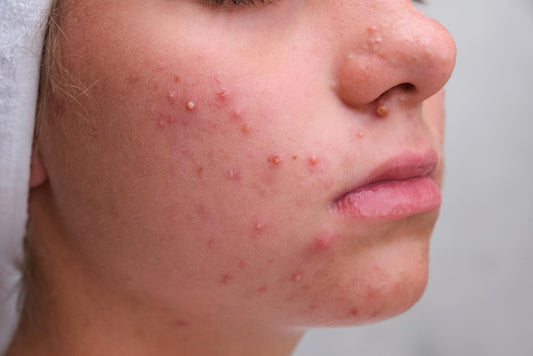 What are 5 facts about acne