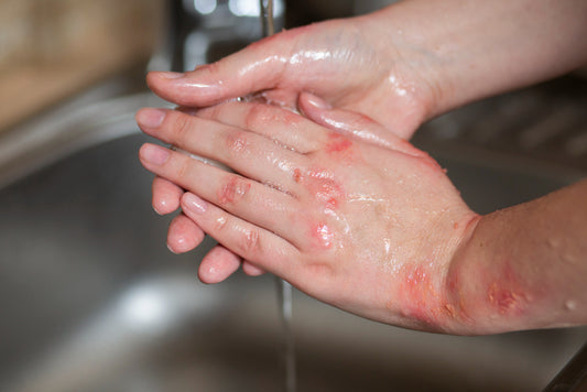 What is eczema and what triggers it