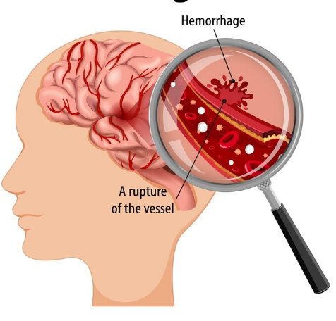 What is the main cause of an aneurysm?